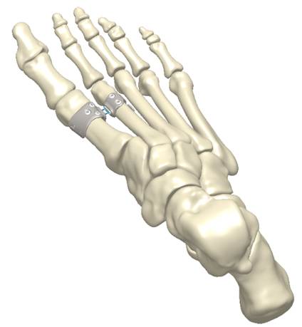 A 3D model of a foot with the HyperFlex™ device connected to the first and second toes