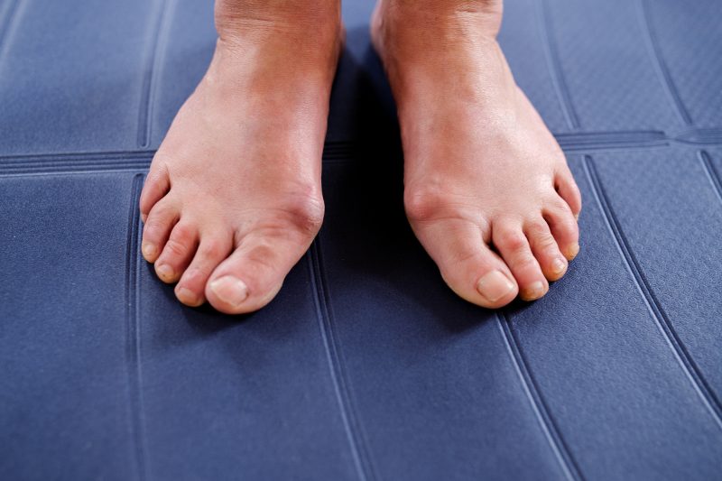 A patient with moderate-to-severe bunions, a condition which has a high success rate for bunion surgery