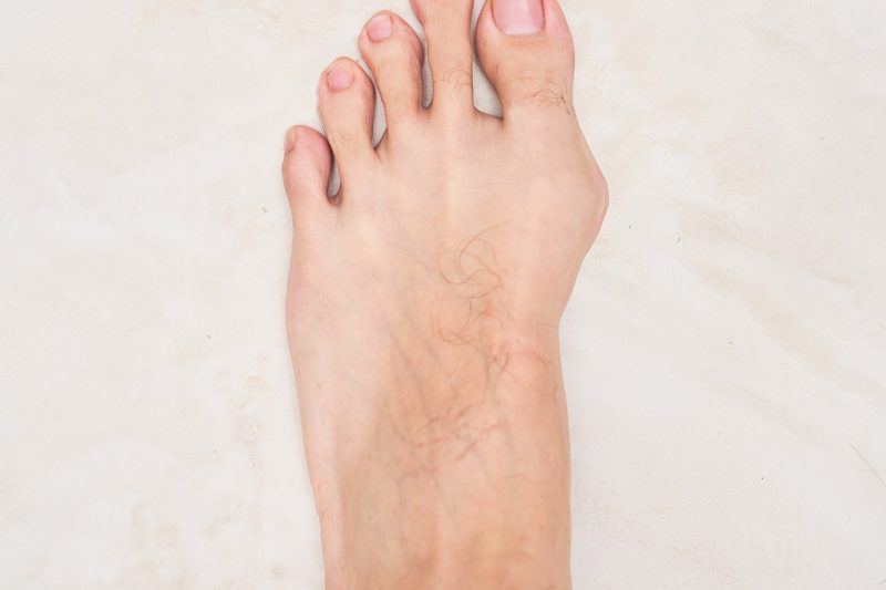 A patient with bunions, who may be an ideal candidate for the best minimally invasive bunion surgery
