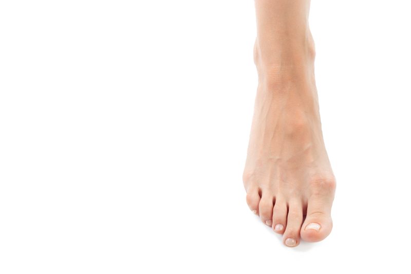 A patient with mild bunions, which can be treated by the best podiatrist surgeons in Westchester, NY