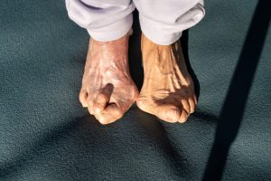 A woman with severe bunions, which can be treated by the best doctors for bunion surgery