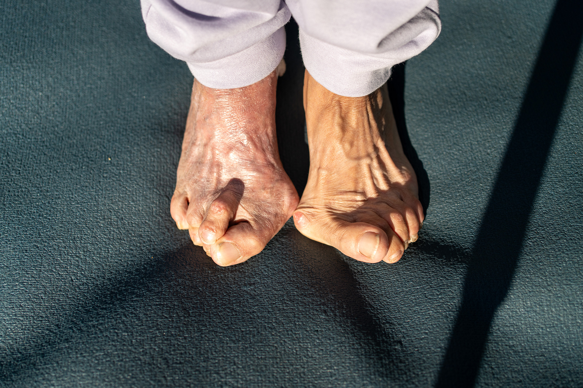 A woman with severe bunions, which can be treated by the best doctors for bunion surgery